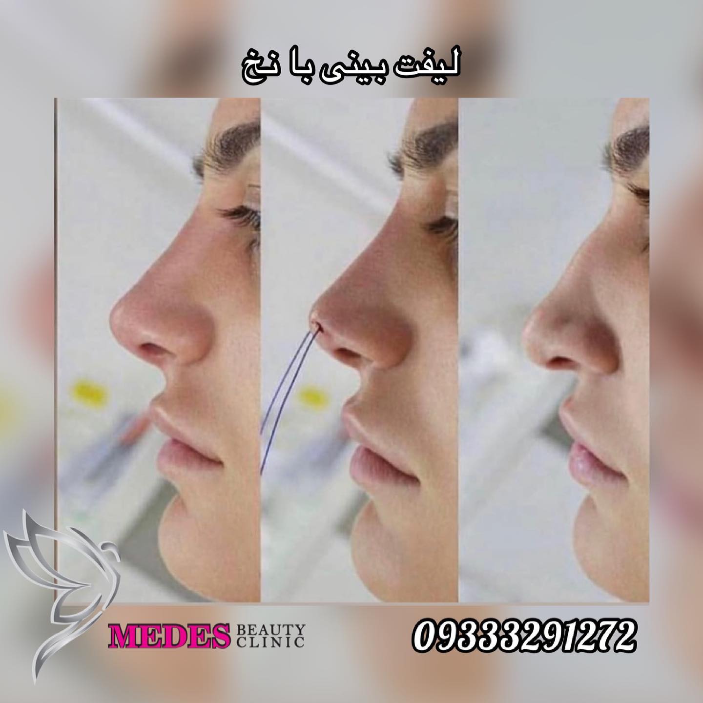 گالری لیفت با نخ